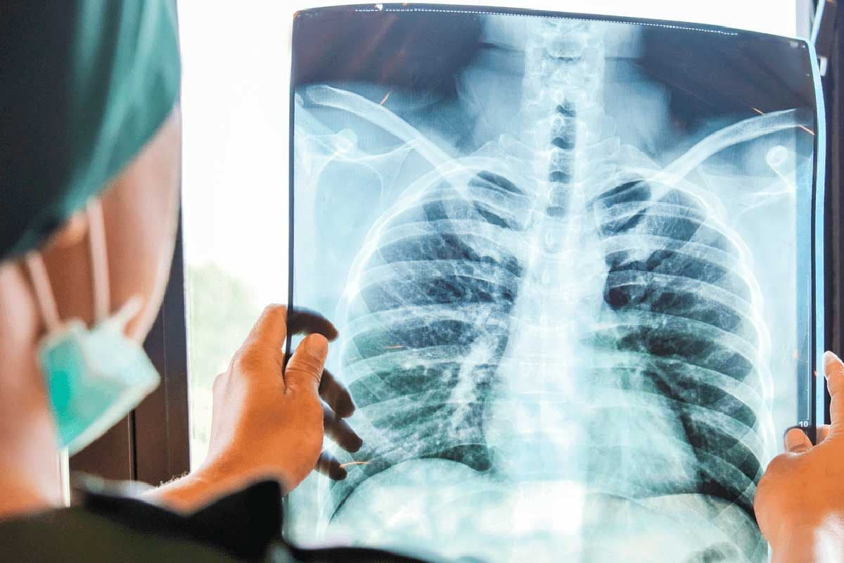 Cáncer de pulmón en Argentina: La importancia de la detección temprana y los desafíos para ampliar el acceso al tamizaje